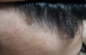 다시한번 M자 상태가 호전되고 있는건지?