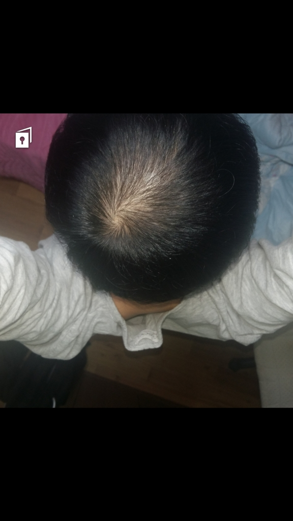 피나 72일째 후기