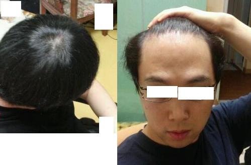 &lt;2014년 9월 현재 정수리, 이마&gt;