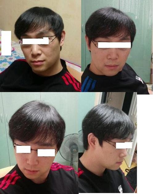 프로페시아 13년차 후기.  <사진 추가>