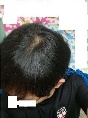 &lt;2014년 9월 현재 정수리. 밝은 불빛 아래서 찍은 모습&gt;