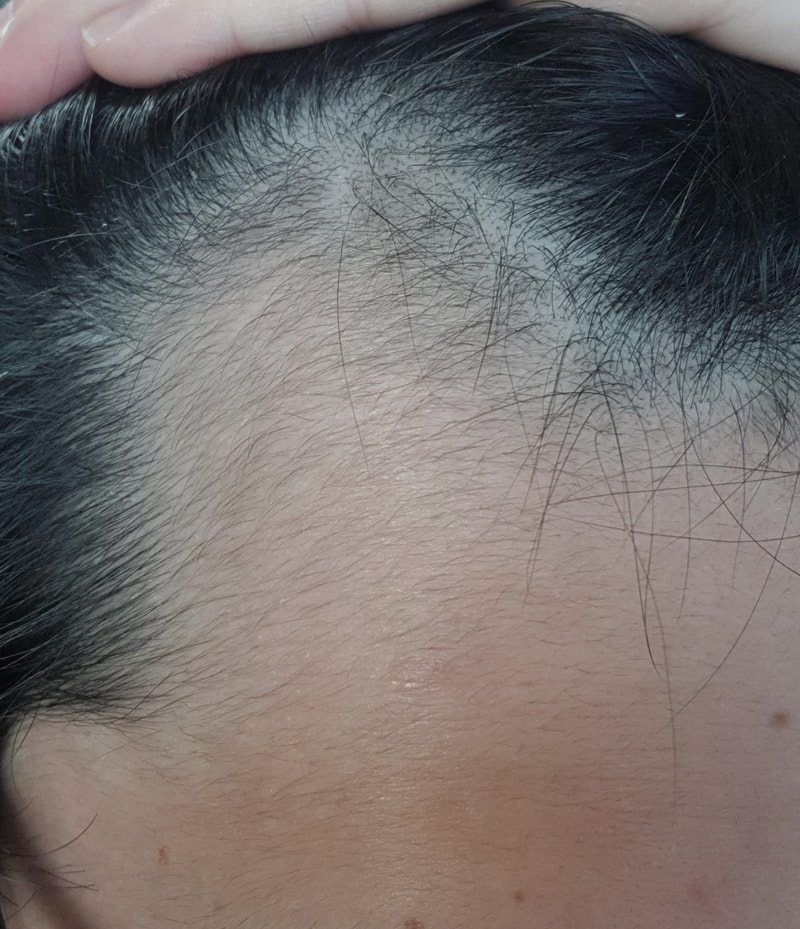 아보다트, 미녹시딜 1달 반 사용한 머리인데 계속해야 할까요?