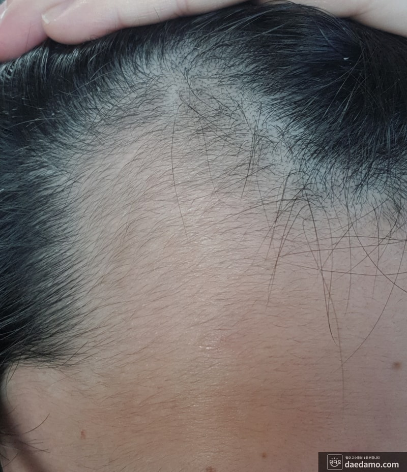 (유전형 M자) 아보다트, 미녹시딜 3달 경과 효과 괜찮네요!