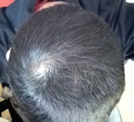 坦率的米诺地尔5%左右，约8周后期。