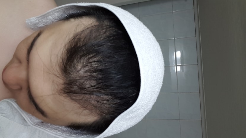약 복용 시작한 당일.