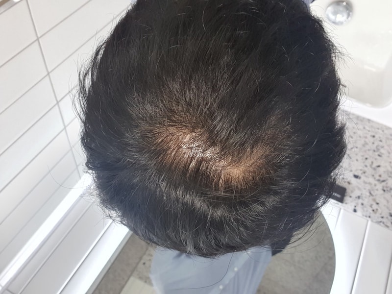 프페,아보,로게인폼 복합복용[23.4.24.자 탈모사진]