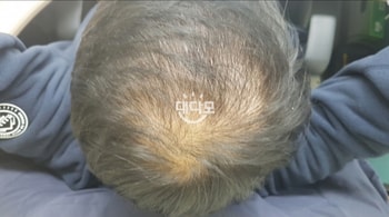 프로스카 복용 시작 당시 