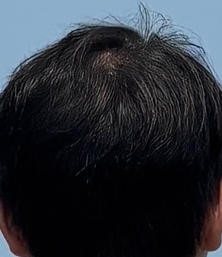 피나스테리드 복용 효과