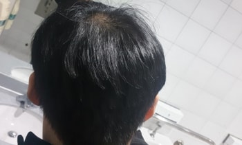 다소 헝클어졌음에도 뒤에서 탈모느낌이 확연함