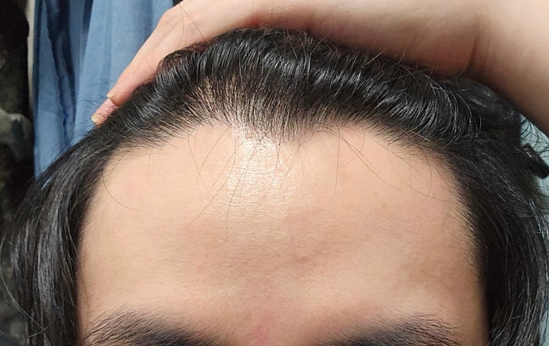 두타 6년차  32세 유전탈모 현상유지?만하는거같네요