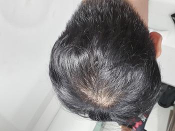 운동직후의 헝클어진 두발모습: 정수리 탈모가 두드러져보임
