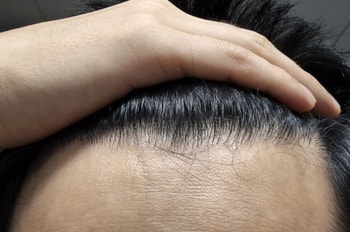 M자입니다(6년전 모발이식 600모낭 했어요)