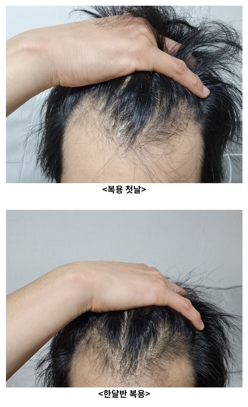 アボダート 3ヵ月半 体験談