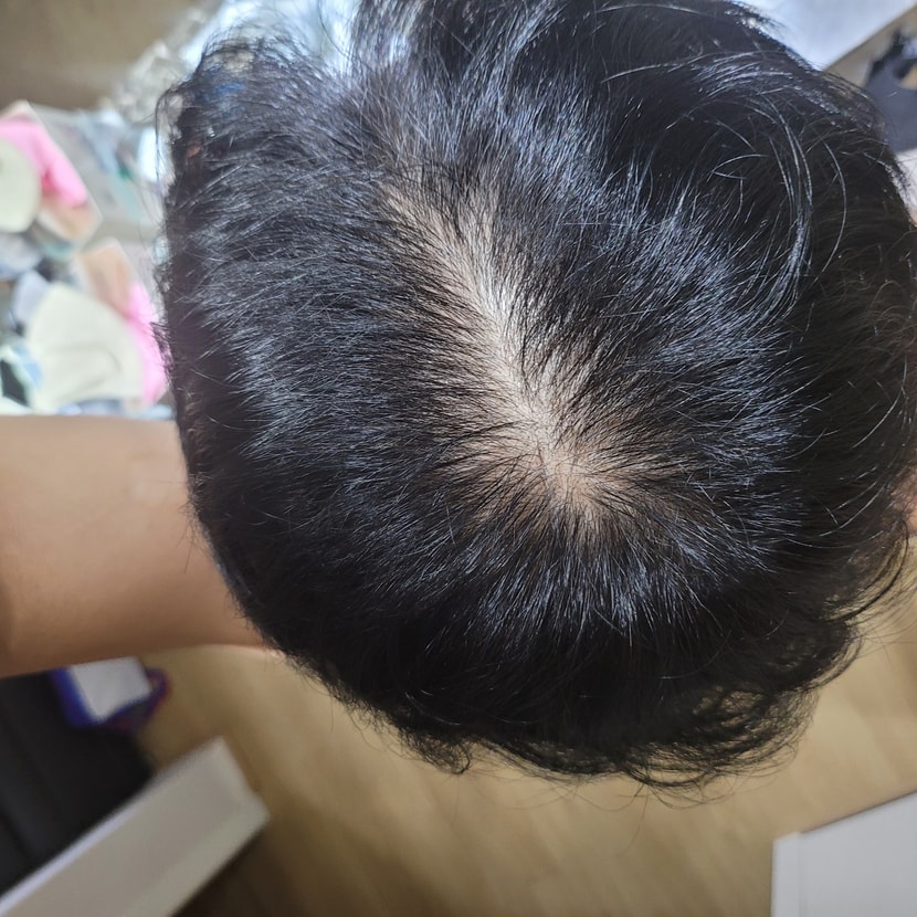 약복용 8개월후