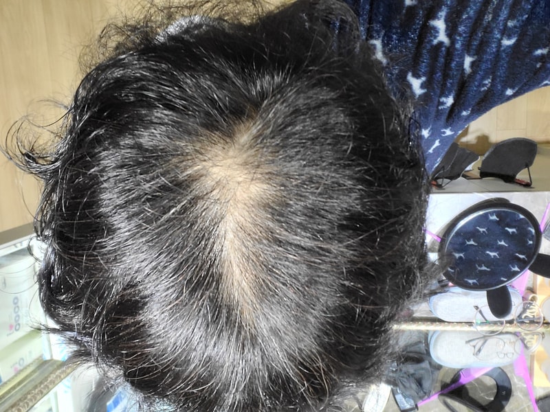 카피약 복용 8개월차 입니다.다시 빠지는 느낌