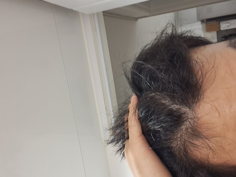 피나계열 5개월차 복용중 후기