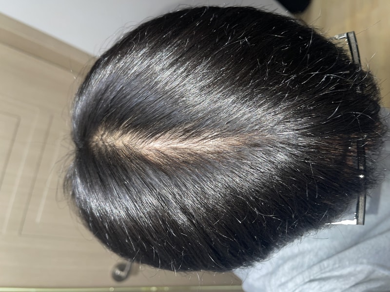 피나스테리드 거진 8개월차 입니다