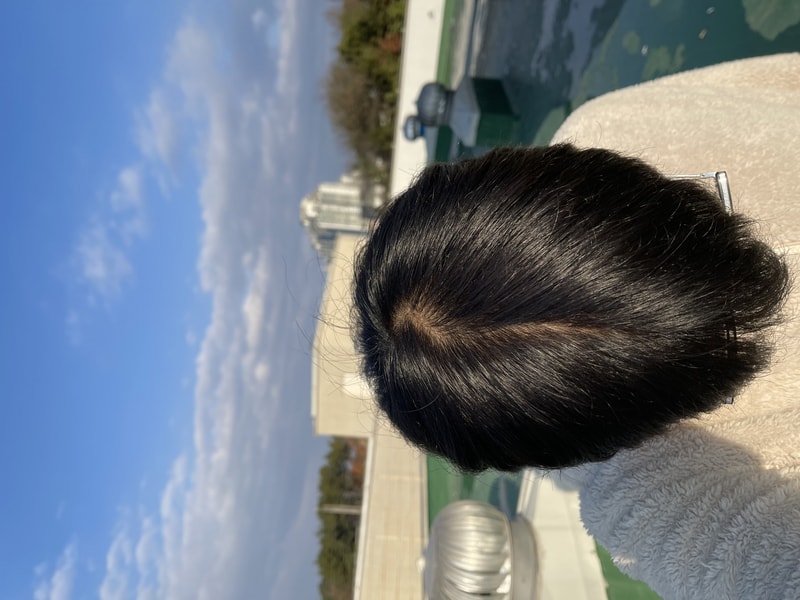 20歳 フィナ中断 1ヶ月パントモナ服用 約2ヶ月後記