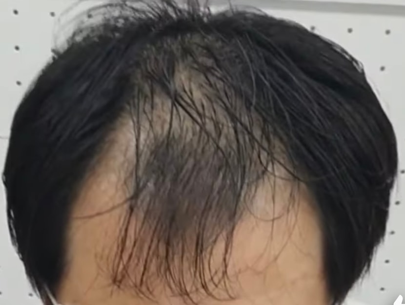 약 복용 5개월전
