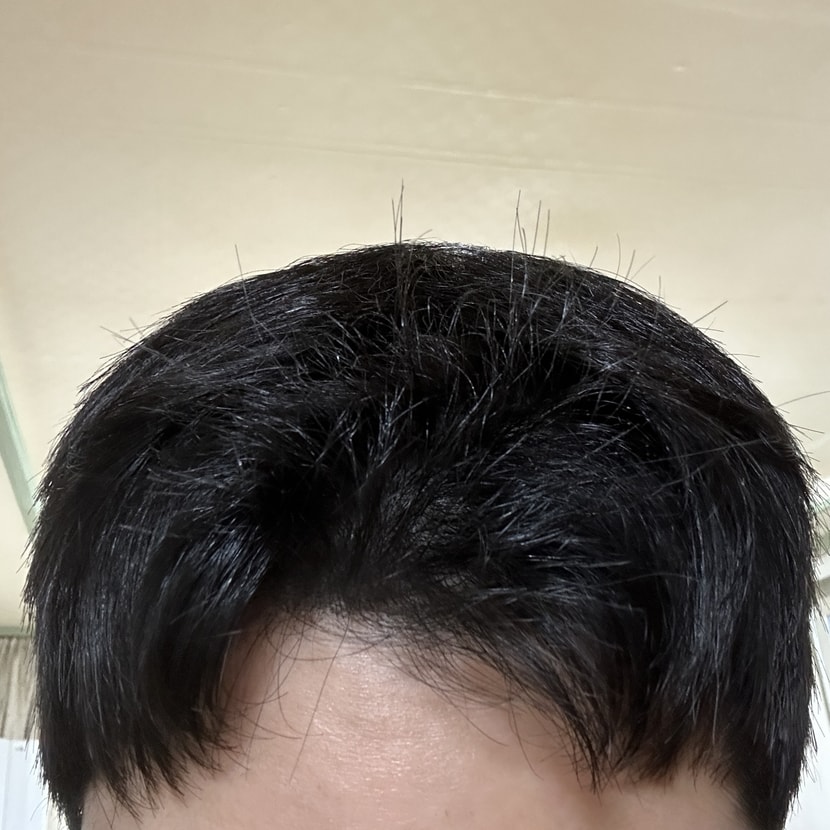 약 복용 5개월후