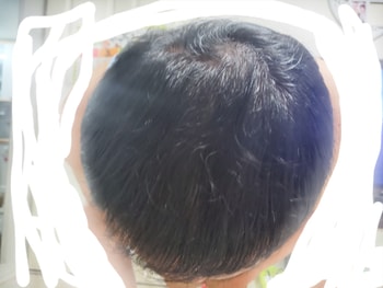 복용 후 90일 사진입니다