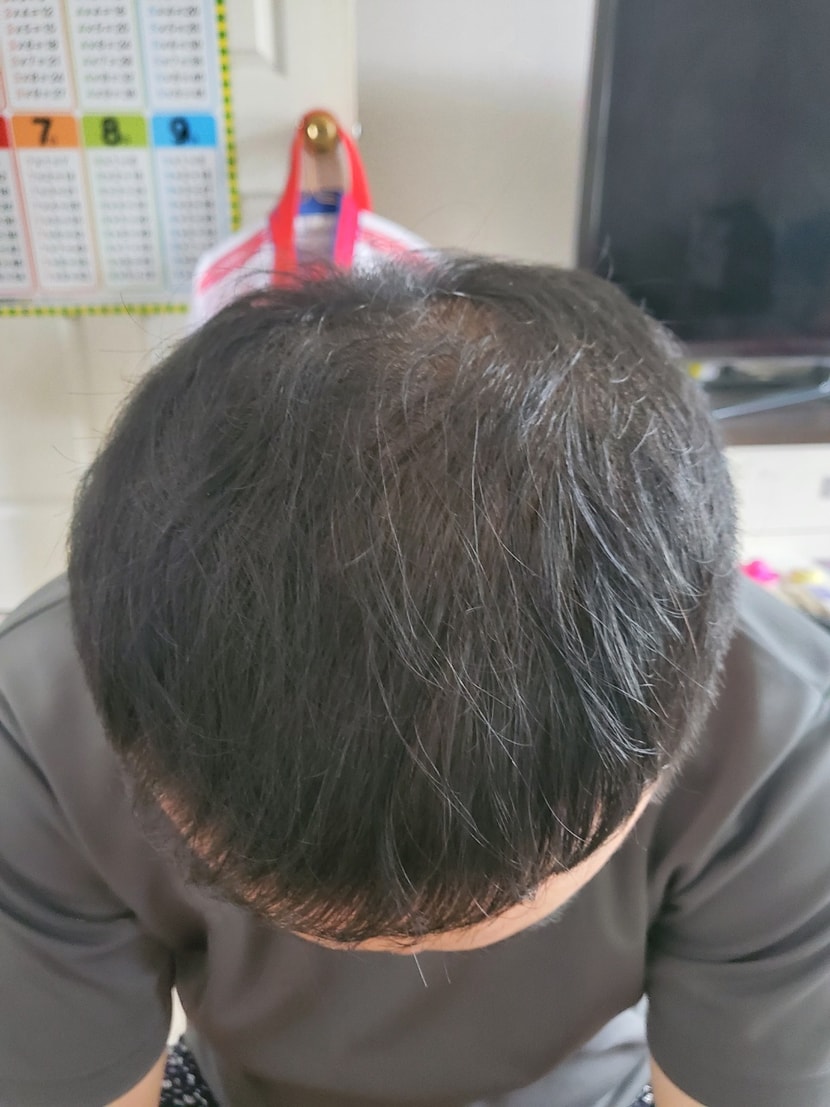 복용 후 30일 사진 입니다