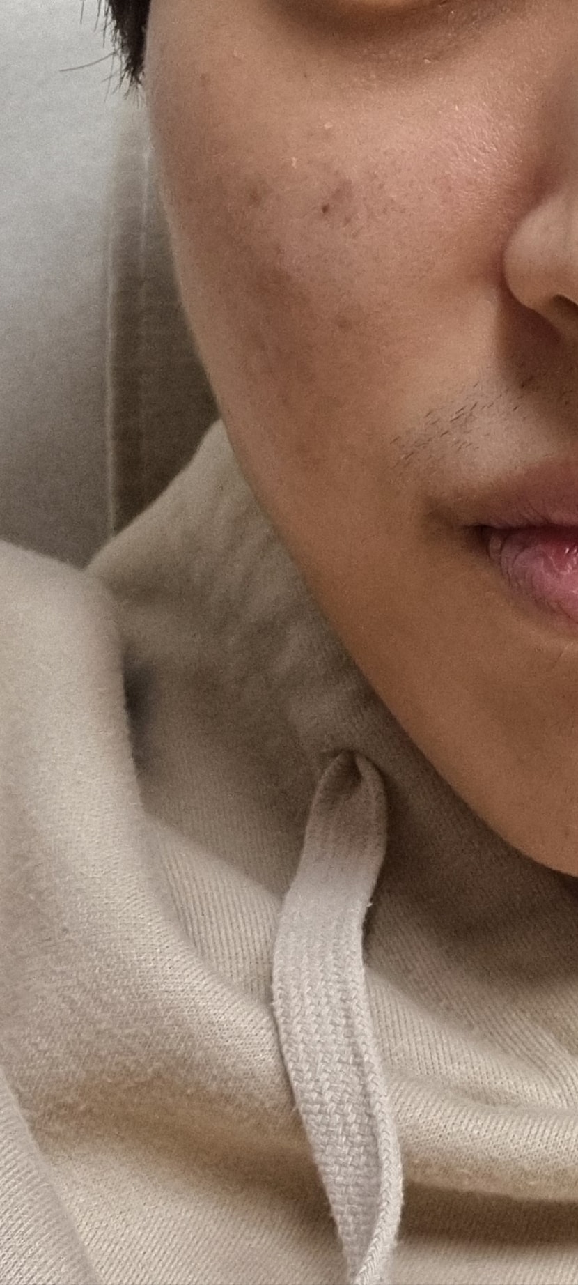 탈모약 복용 후
