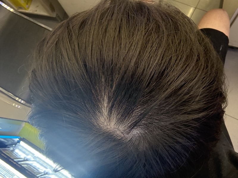 아보다트 5개월 후기