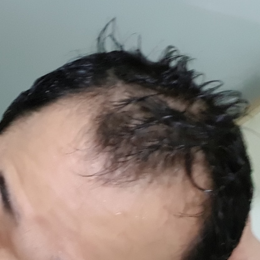 약먹기전 1년전
