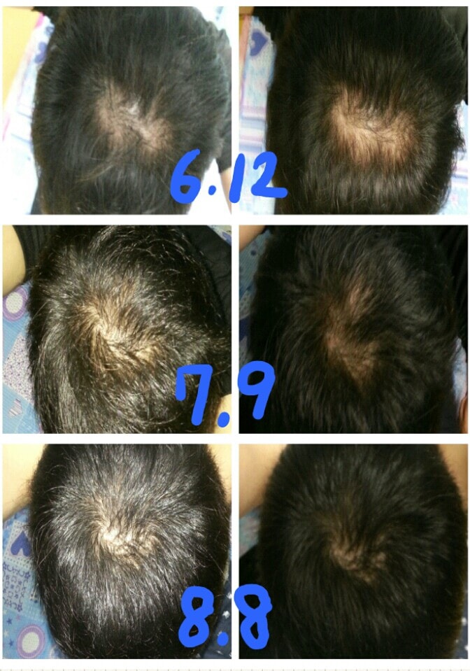 是莫纳德·郑3个月后期。 现在好像看到了效果。