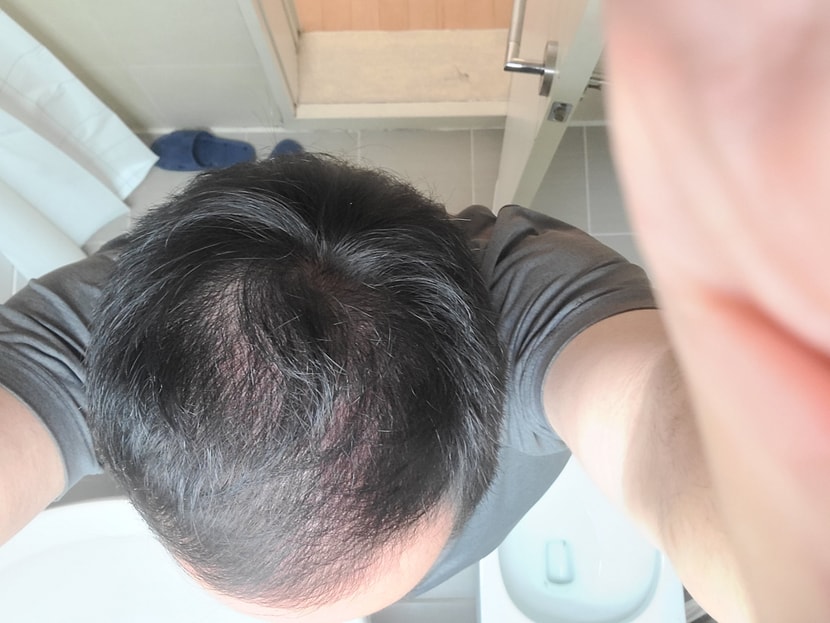 약 복용 10개월차