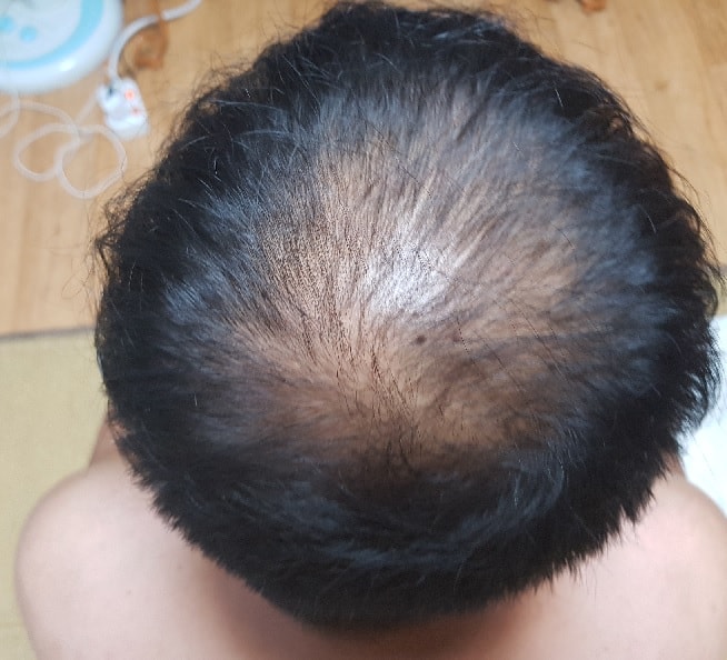 미노페시아 4개월차 경과사진입니다.