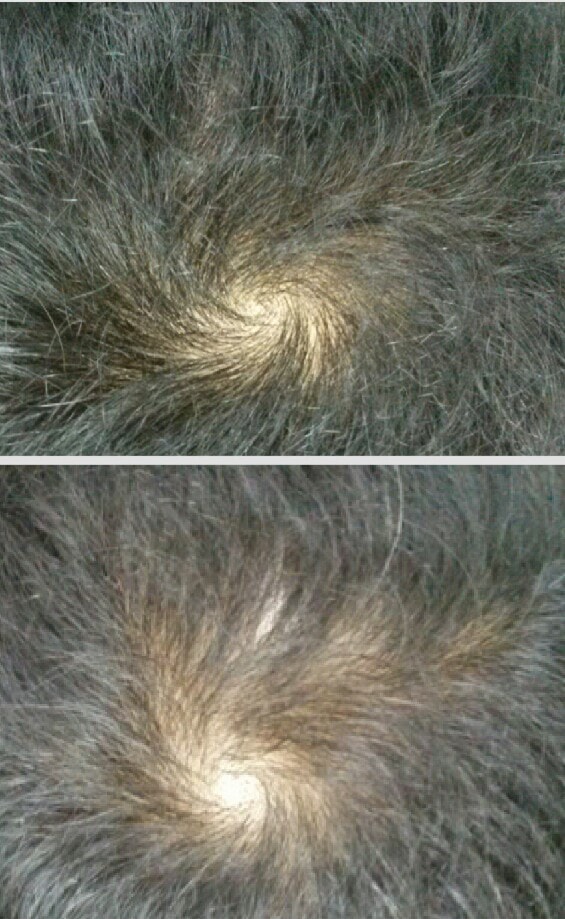 프로페시아 8개월..