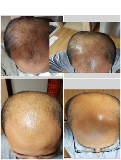 약 먹은지 130일 경과 후기