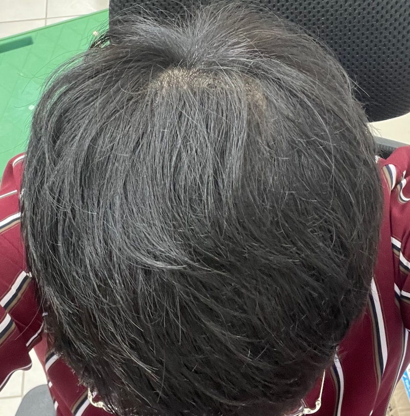 Abodat + Minoxidil review about a year and a half