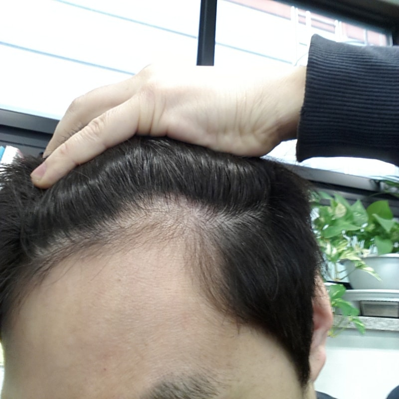 是Propecia的一个月后期。