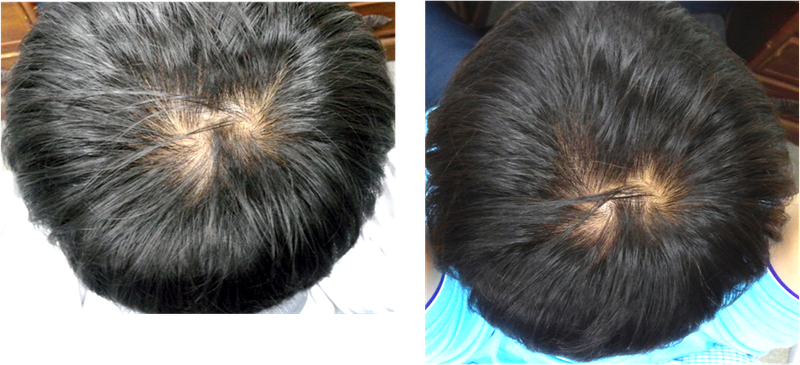 服用阿凡达4个月..前后对比照片