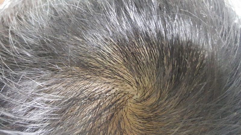 Comparison before and after 1 year of Propsia