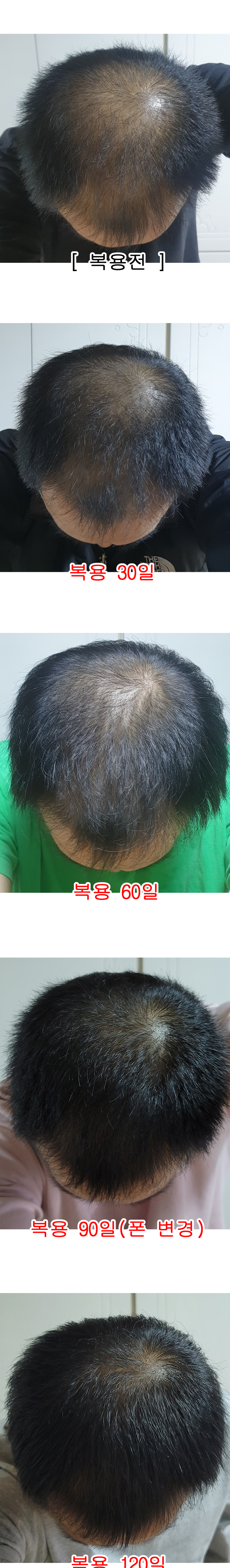 탈모변화a