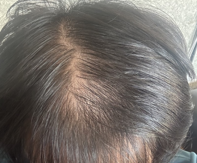 미녹시딜 3개월 복용