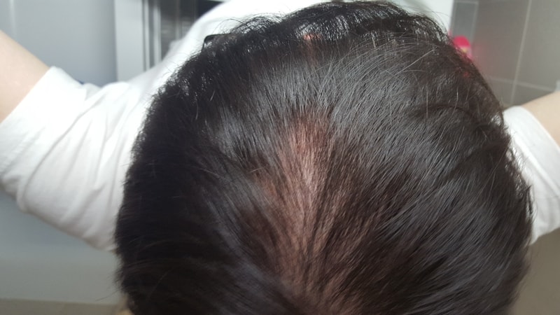 I took Propecia for 3 years.