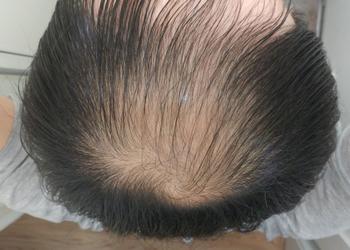 치료 전 정수리