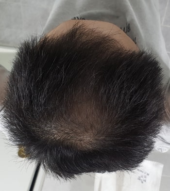 3년 치료 후 정수리