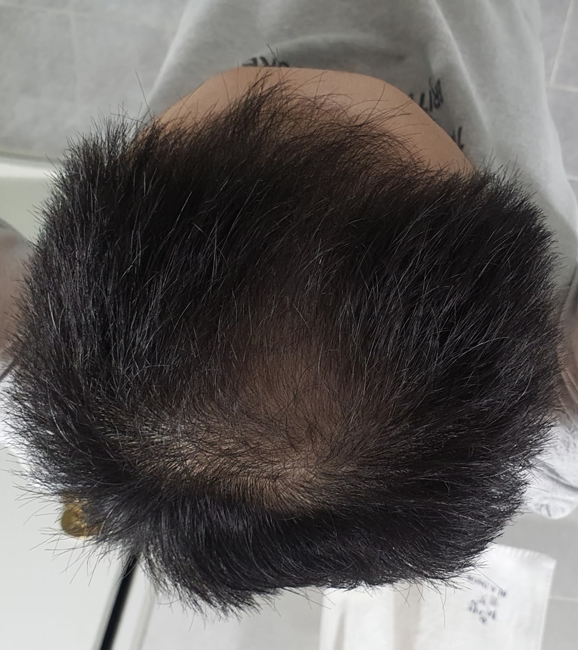 3년 치료 후 정수리