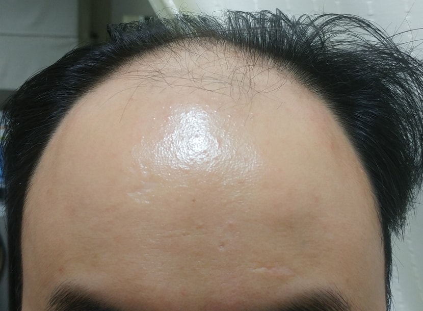 치료 전 이마