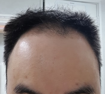 3년 치료 후 이마