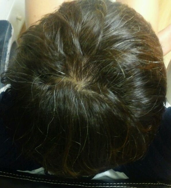 Finfessia+Minoxidil 4个月后期