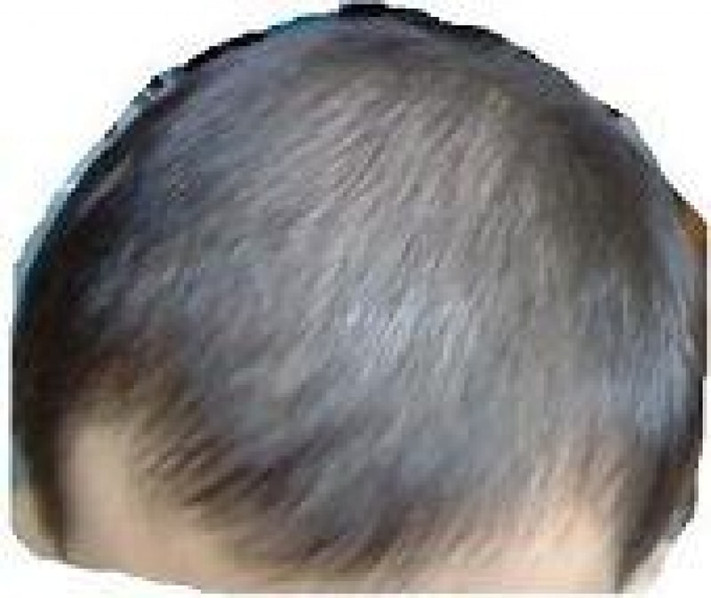 25세 프페 2달 복용 후기?입니다.