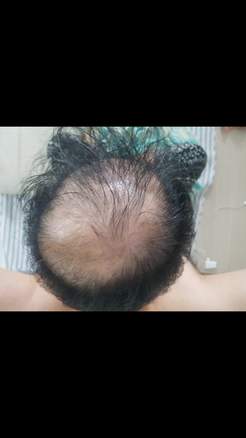 피나계열 복용 첫날 입니다.