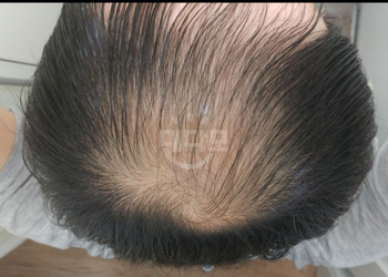 치료전 정수리